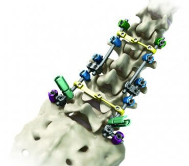 Streamline® TL Spinal Fixation System