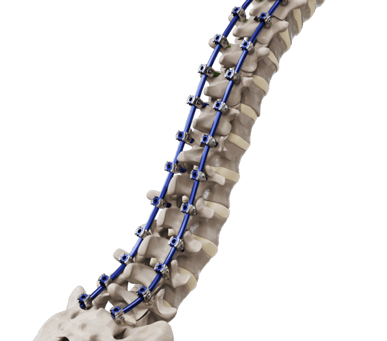 Cortera® – Open Posterior Fixation System e1762804952942